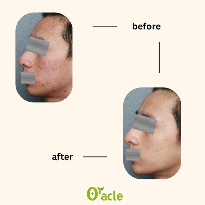 before and after example from oracle dermatology