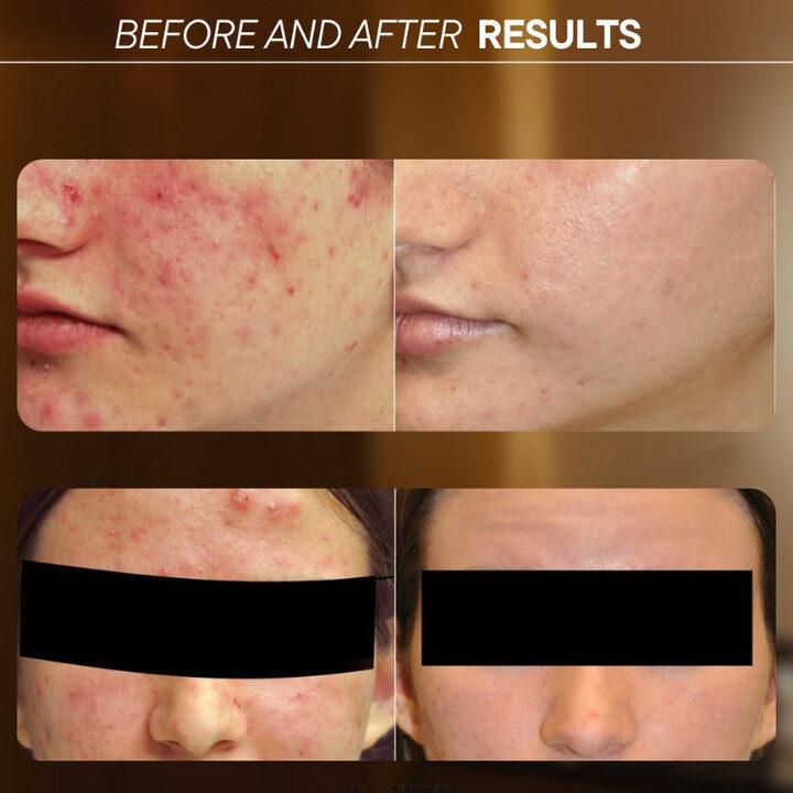 before and after from Renovo Skin Clinic